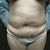 This is my abdomen before the abdominoplasty