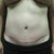 After the abdomen surgery