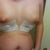 day 1 post op