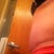 POD 17 Side View - Still swollen but so much better than it was. I'll try to post a before side view for comparsion.