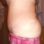 One side.  Of course I still have my stretch marks but no one sees those when I am dressed