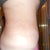 My TT was done on Oct 21, 2011 it has been almost 13 months.  Everything healed great and you can see the scar is very light and thin.