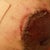 other nipple bleeding and peeling