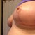 Left breast at 38 days post op.