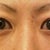 Before-1 month pre op.  Very heavy uneven upper lids with excessive fat and skin.  Right eye lid lays over eyelash line