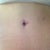 Belly button scar 6 month po