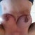 2 week post op..the scabby look is being held on by the glue..its just starting to fall off :-)