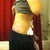 post op day 1, I am pretty swollen still, but no more dunlap yay!!