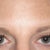 after eye surgery 2 mos, still a little puffiness in left eyelid