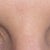 after eyelid surgery day 12
