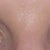 after eyelid surgery day 9