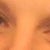 before eyelid surgery