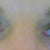 after eyelid surgery 2 mos, still a little puffiness in left eyelid