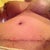 PO Week 3 Shows how the scabs are coming off.  Not pretty but gives people an idea on what 21 days look like.