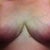 4 Weeks!!!   Incisions are pretty much completely healed except a bit around my nipples.   But i do see those spots closing up so it won't be long!