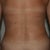 6 weeks post op and right after taking off my garment, hence the marks on my skin