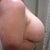 Right side before explant