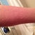 My leg broke out into hives from being overheated - if this occurs, make sure to not ignore the signs and use aloe Vera before it turns into real burns!