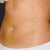 R oblique 8 weeks later