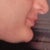 Before. Can be compared w previous pic. Gained weight here. Went to address double chin. Almost as an afterthought, I mentioned if something could be done about chubbiness of cheeks chin. Biggest mistake of my life. But the worst part has been his utter dismissal of me.