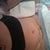 Day 1 Post Op