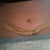 Day 1 Post Op