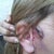 This was after the second surgery to repair a stitch the came loose. The Dr. Pulled my skin too tight and it peeled off the side of my face. No Problem, he says, I can fix it..
