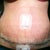 1 week post op