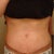 Looking pretty good! Still some swelling left in the lower abs and pelvic area