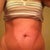 2 weeks post op--standing straight up