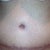 Scar day 18 - notice the swelling especially on the sides...right side is slightly more swollen. Also, can't see well in pic but have swelling in mid region below belly button down to scar...it's not horrible, but I can definitely tell the difference as day goes on...but never really get's much worse than this.