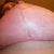 5weeks underside of left breast