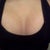 post-op day 2 : with a sports bra