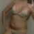 post-op day 7: bikini