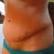2012 - 11 & 1/2 months post tt & 1 week post scar revision - My bad side - where the dog ear was & the scar was higher, as you can see I am very swollen!