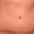 Eleven weeks post op, pre workout