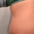 Eleven weeks post op, pre workout, side view