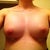 Post-op day 5