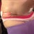 My left side. After revision surgery.  Bloody bandage has to stay til next week.