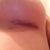 Incision left 3 weeks
