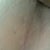 Scar 6 wks 2 days