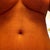 Week 4 incision scars