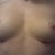8 days post op.