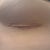 R incision. L is same but a slightly larger and more uneven.