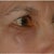 Sculptra Under the Eyes - a Very Bad Idea?