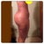 2 weeks post- op- side shot