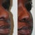 Quick Facts about Ethnic Rhinoplasty: Interview with Dr. Rod Rohrich        