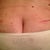 Post Op 34 back scar.  And no the vertical line is NOT a scar - Lol ;)