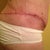 Post Op 34 right side scar