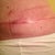 Post Op 34 left side scar